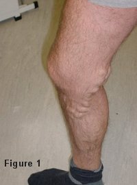Varicose Veins