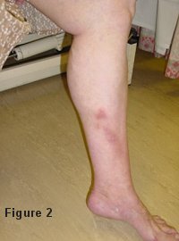 Varicose Veins